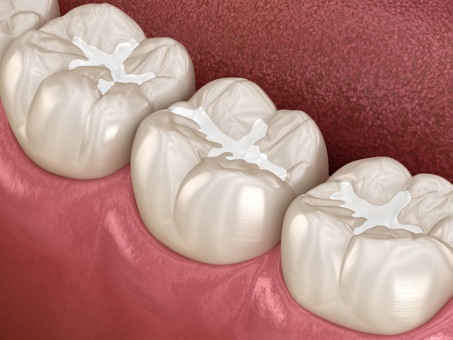 I Need A Dental Filling