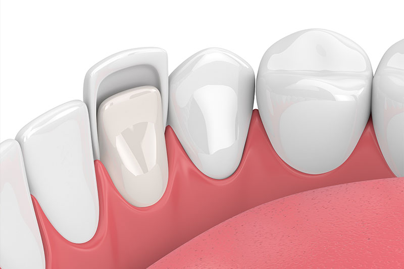 Porcelain Veneers in Bainbridge